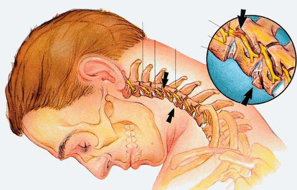 Stadi dell'osteocondosi della colonna cervicale